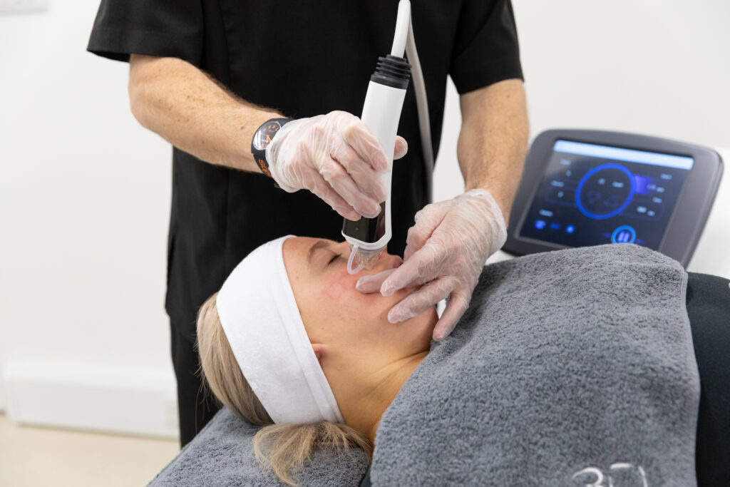 Microneedling treatment in progress at Skin Redefined in Cheltehmam