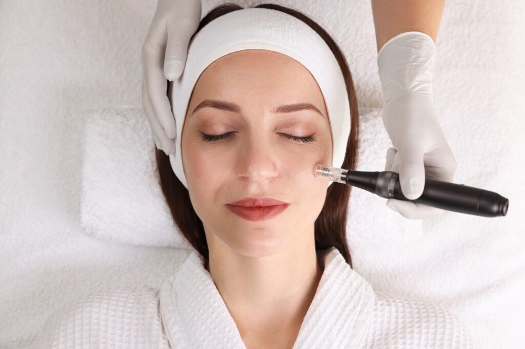 Micro Needling Treatment in progress at Skin Redefined in Cheltenham