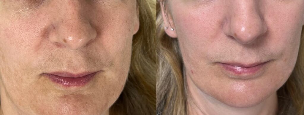 RF Microneedling Results at Skin Redefined in Cheltenham